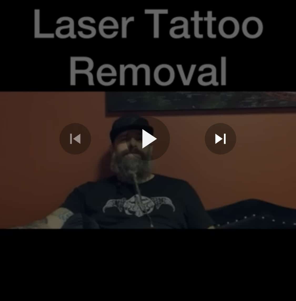 laser tattoo removal